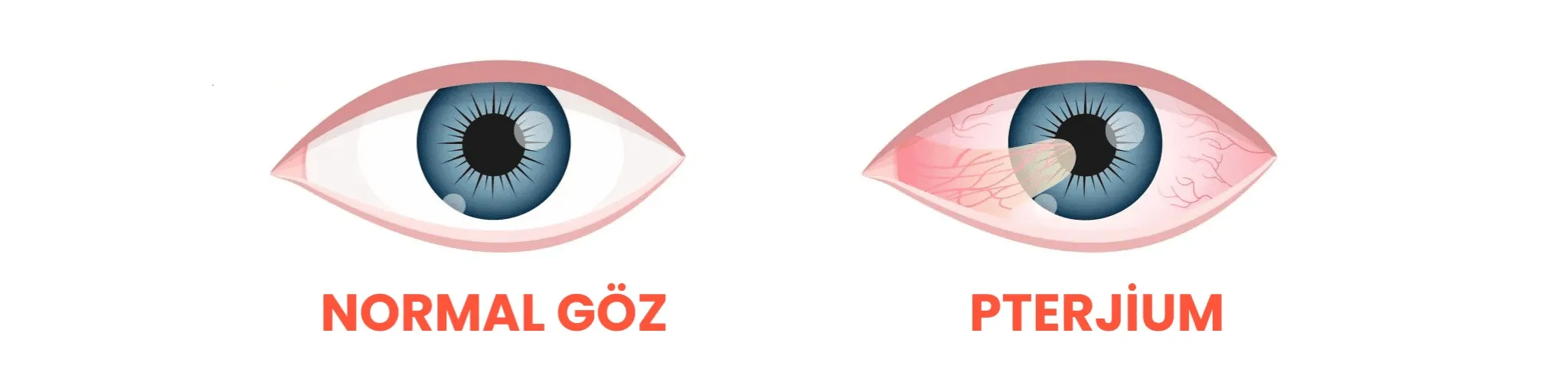 Pterygium