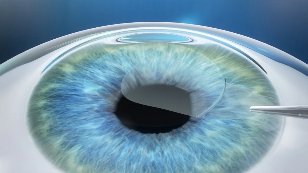 ReLEx SMILE PRO eye surgery in Turkey