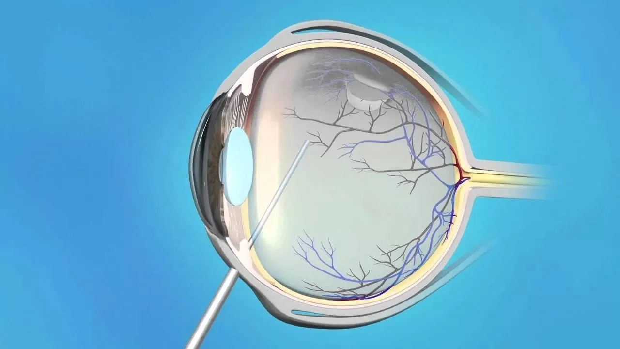 Retinal thinning