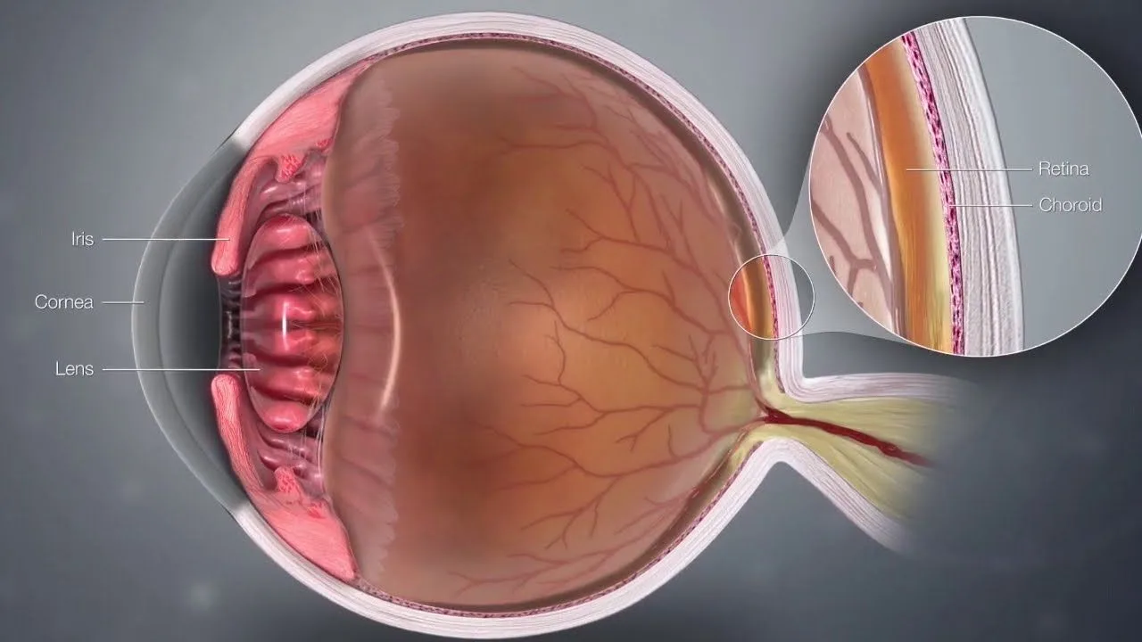 Retinal thinning examination