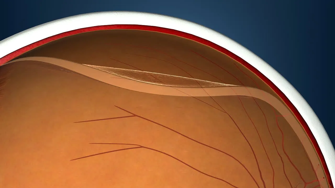 Symptoms of Retinal Thinning