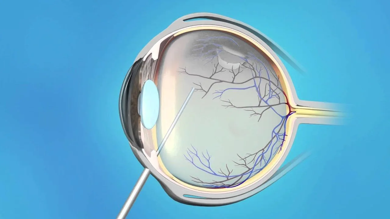Symptoms of a Retinal Tear