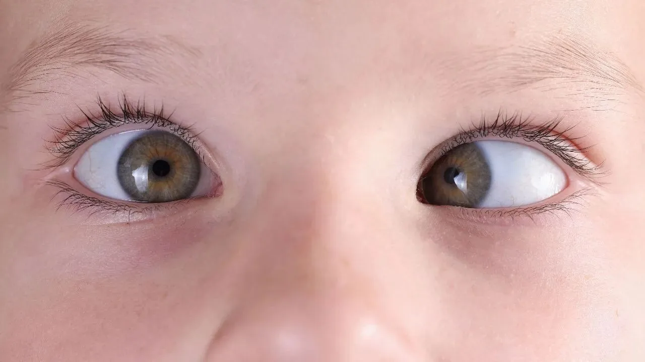 What Causes a Squint?