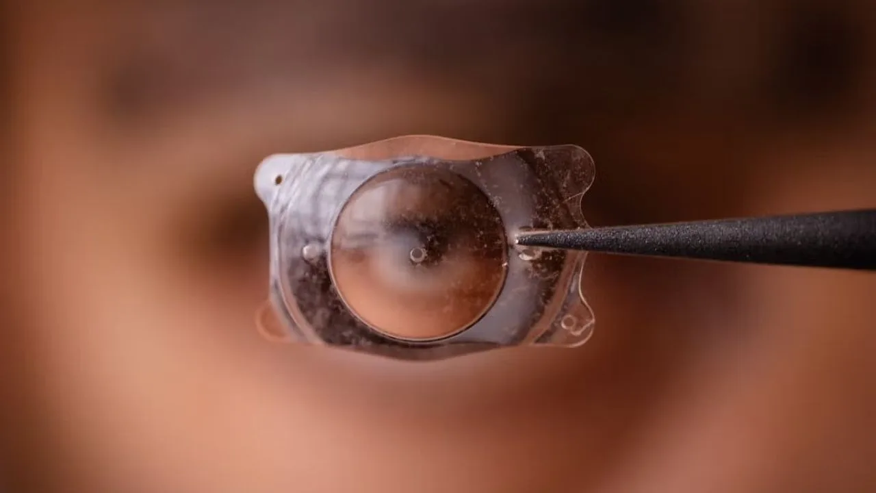 Multifocal lens replacement surgery Turkey