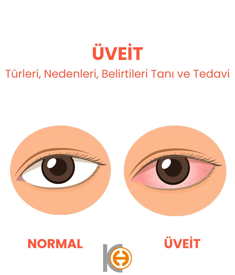 Uveïtis