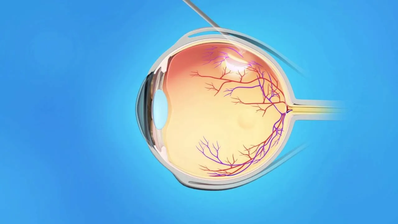 Vitrectomy