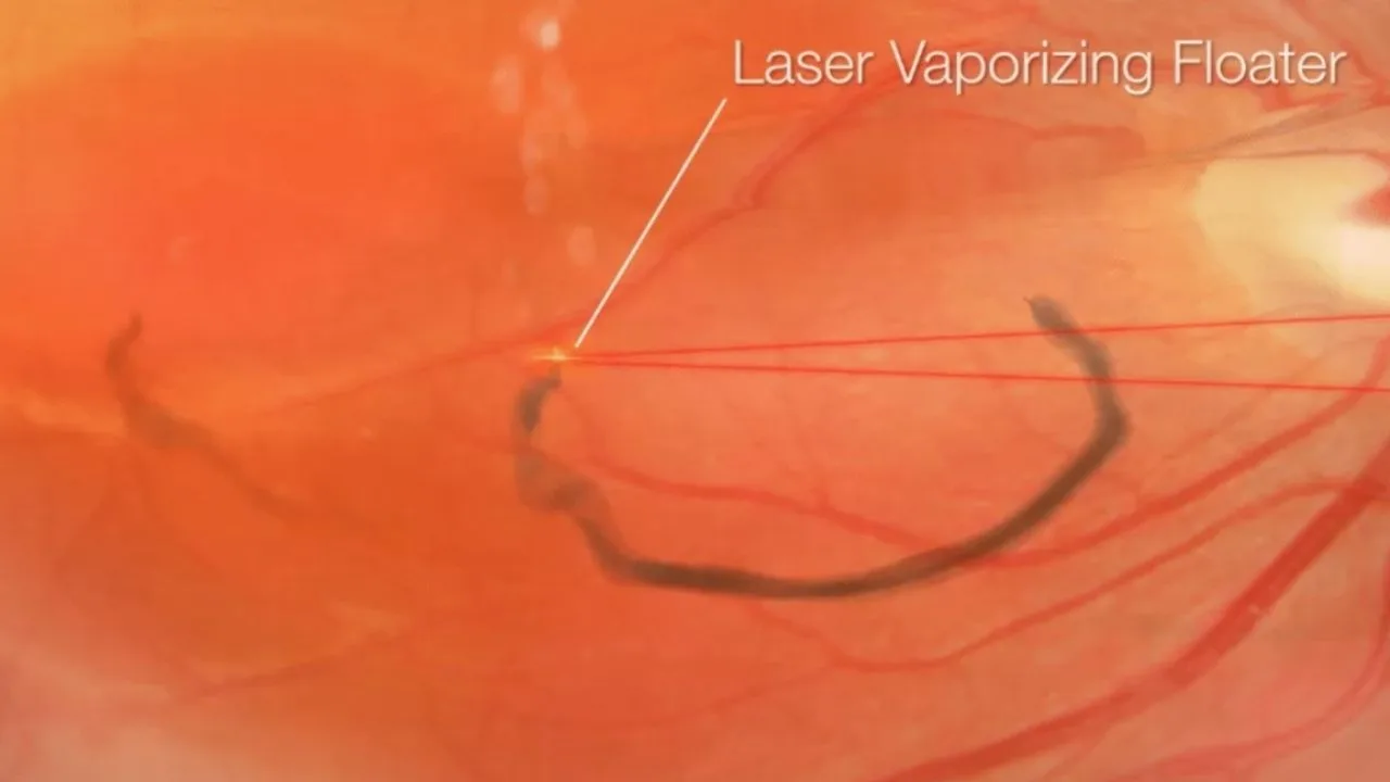 Treatment for Floaters in Eyes