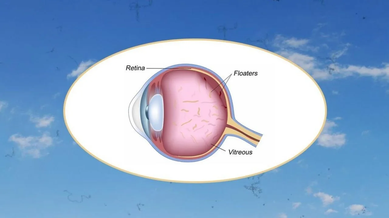 Treatment for Floaters in Eyes