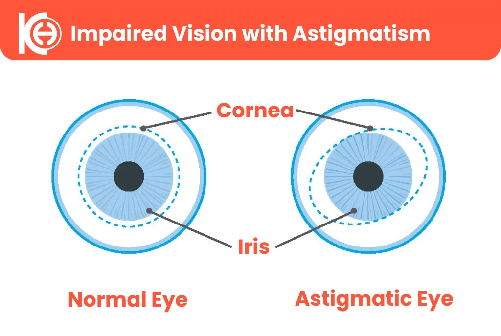Astigmatic eye