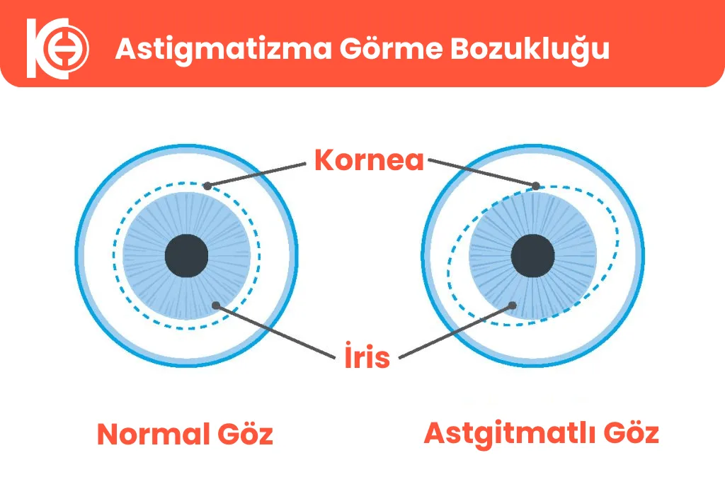 Astigmatisme