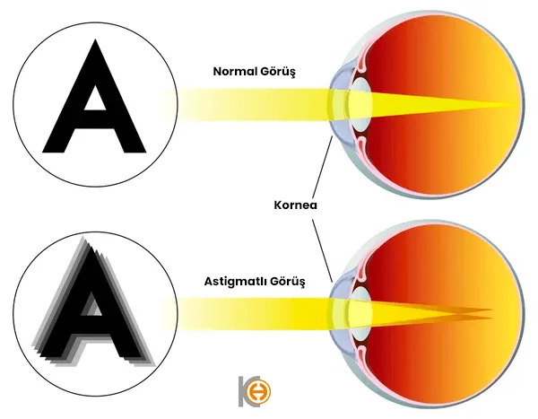 Astigmatisme en een normaal oog