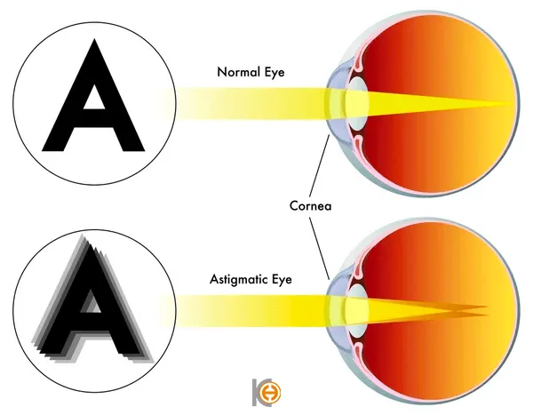 Astigmatvsnormal