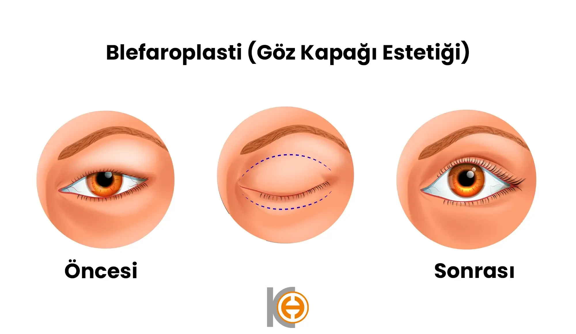 Oogcontour en ooglidesthetiek