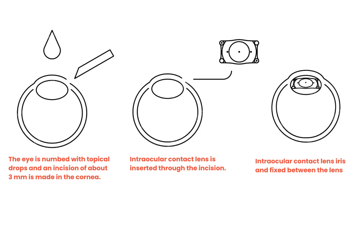 Schema van het plaatsen van een intraoculaire lens in het oog