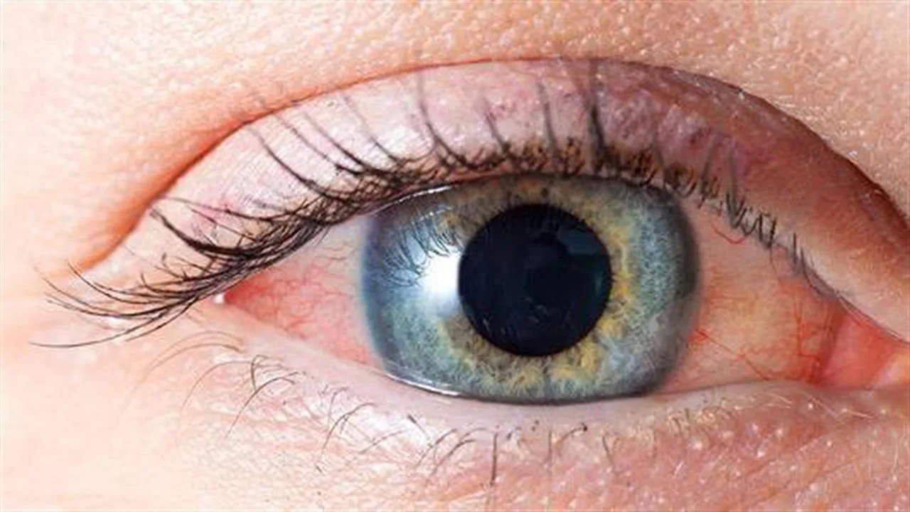 What Causes Stinging Eyes and How Does It Clear?