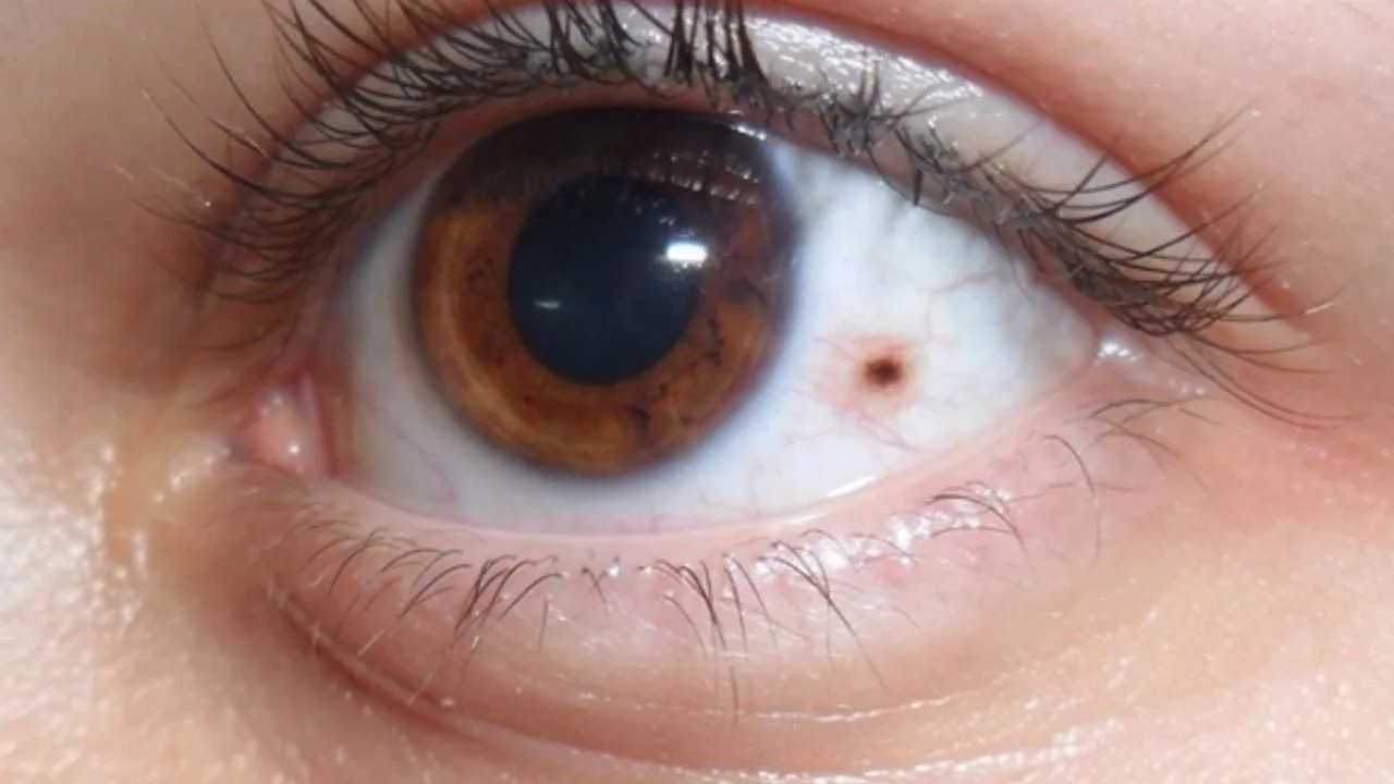 Wat is een moedervlek in het oog?