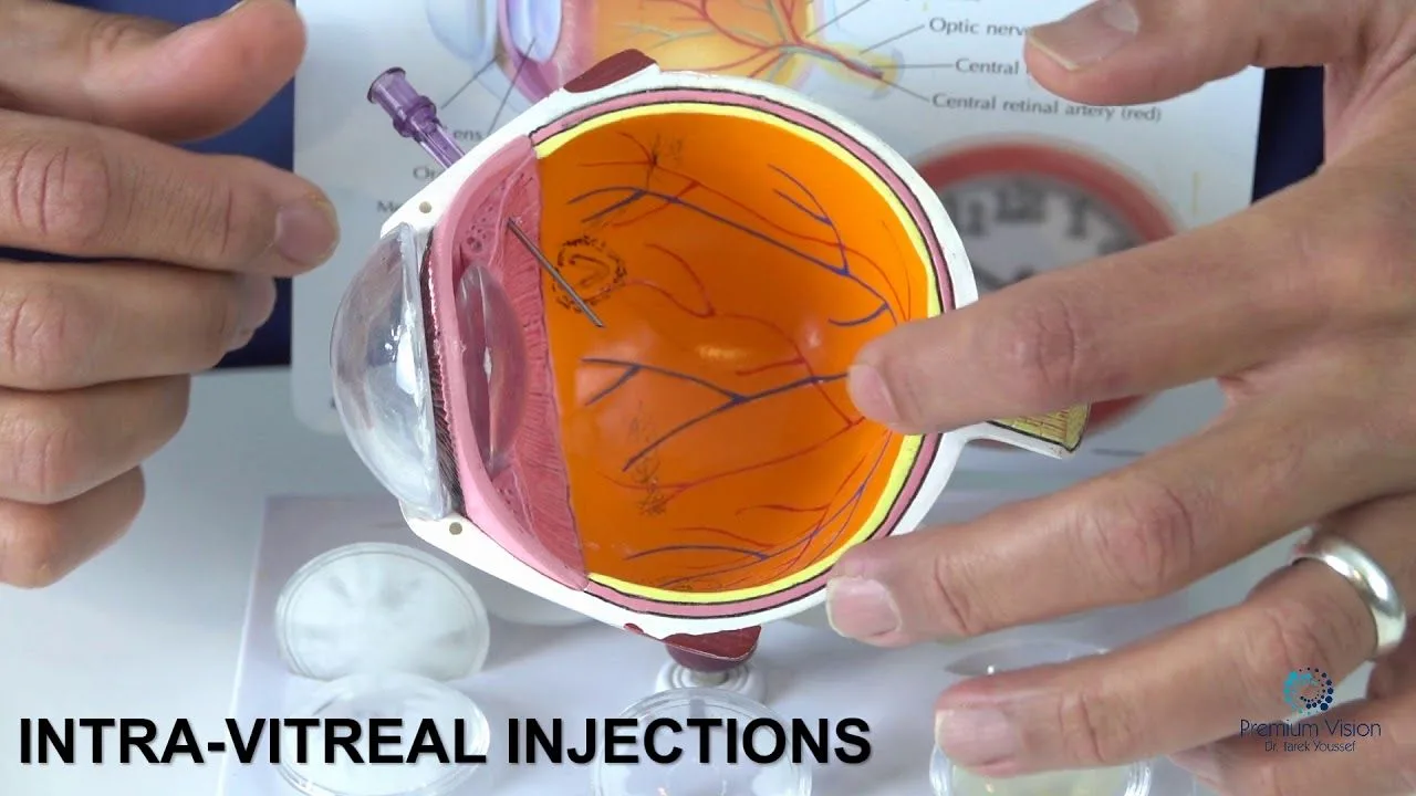 How is an Eye Injection Given?