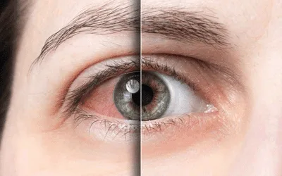 Attention to Eye Haemorrhages!