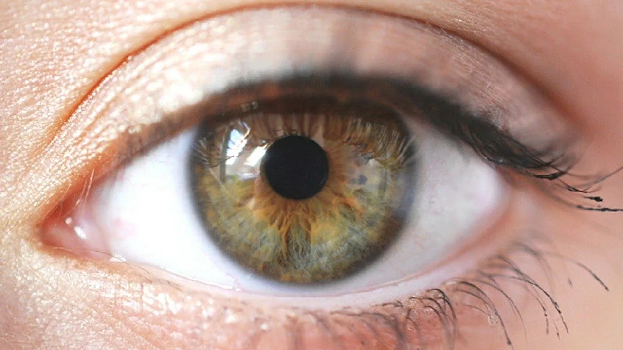 Cataract
