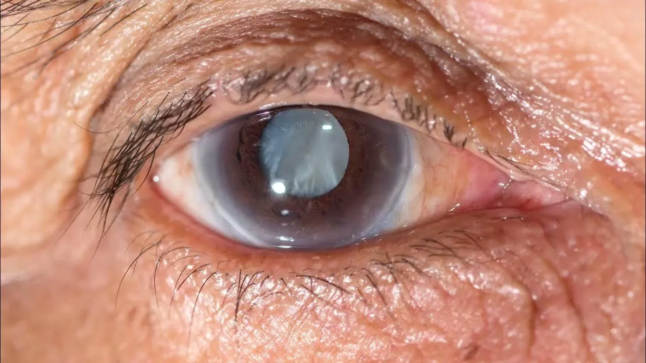 Klachten bij cataract in het oog