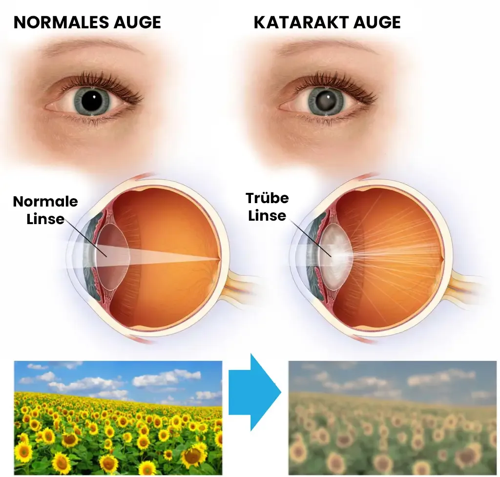 Katarakt bulutlu normal