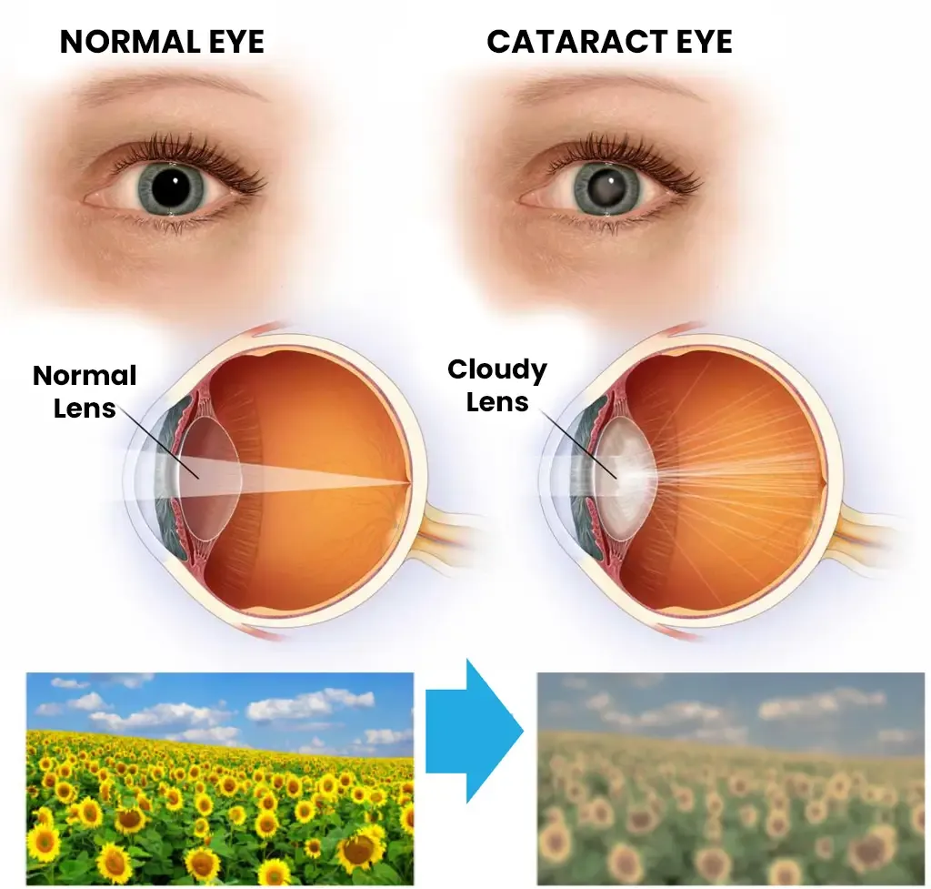 Cloudy lens with cataract and a normal lens