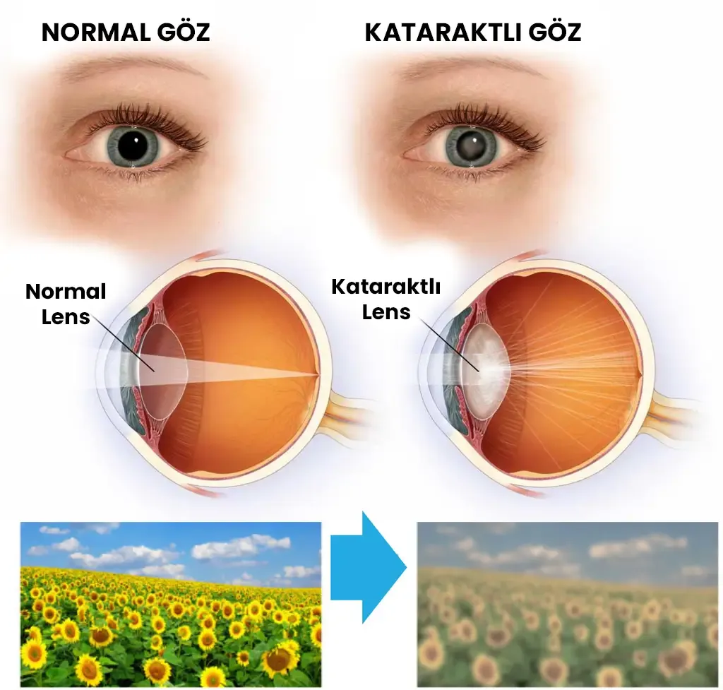 Katarakt bulutlu normal
