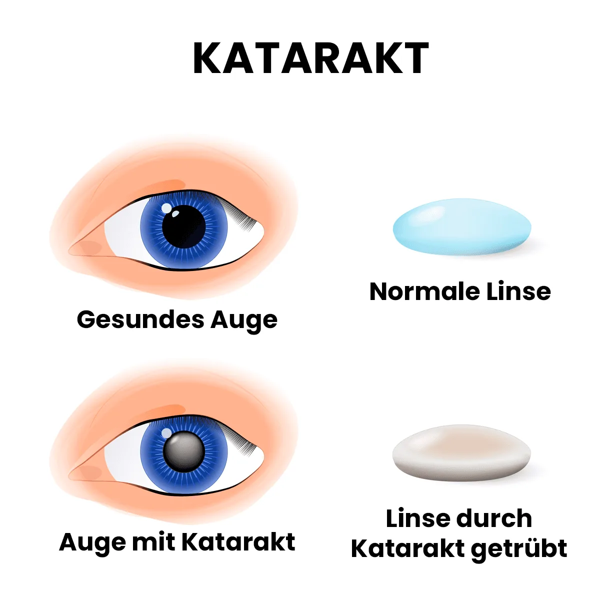 Katarakt nedeniyle bulaniklasmis