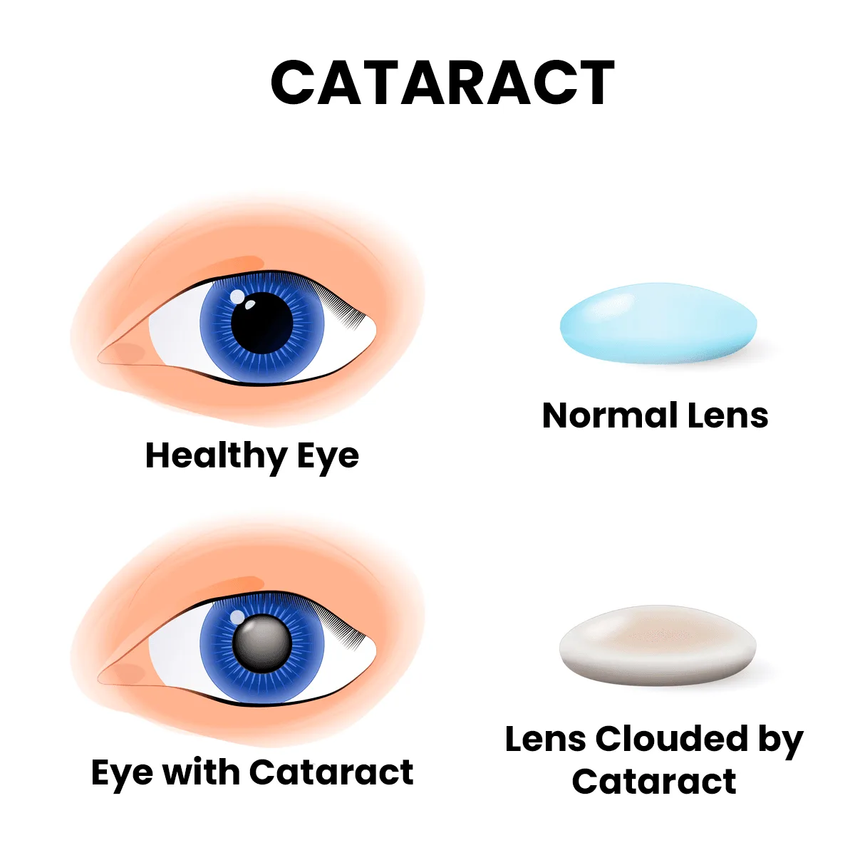 Vision blurred by cataract