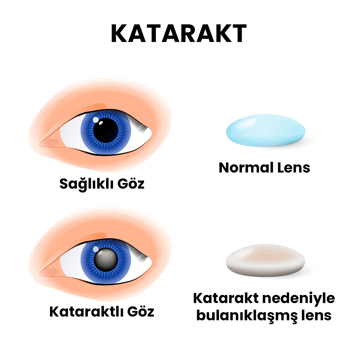 Katarakt nedeniyle bulaniklasmis