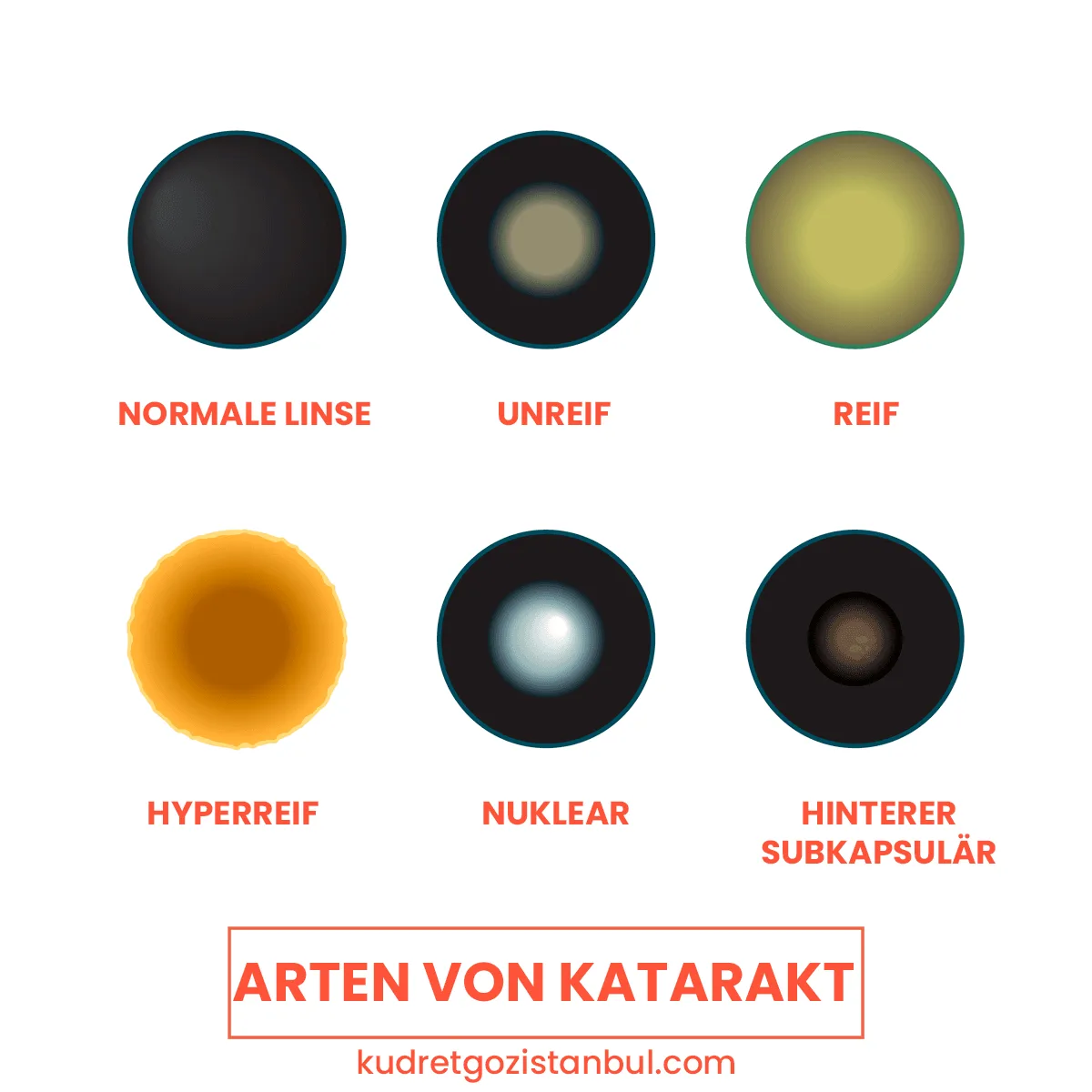 Katarakt tipleri
