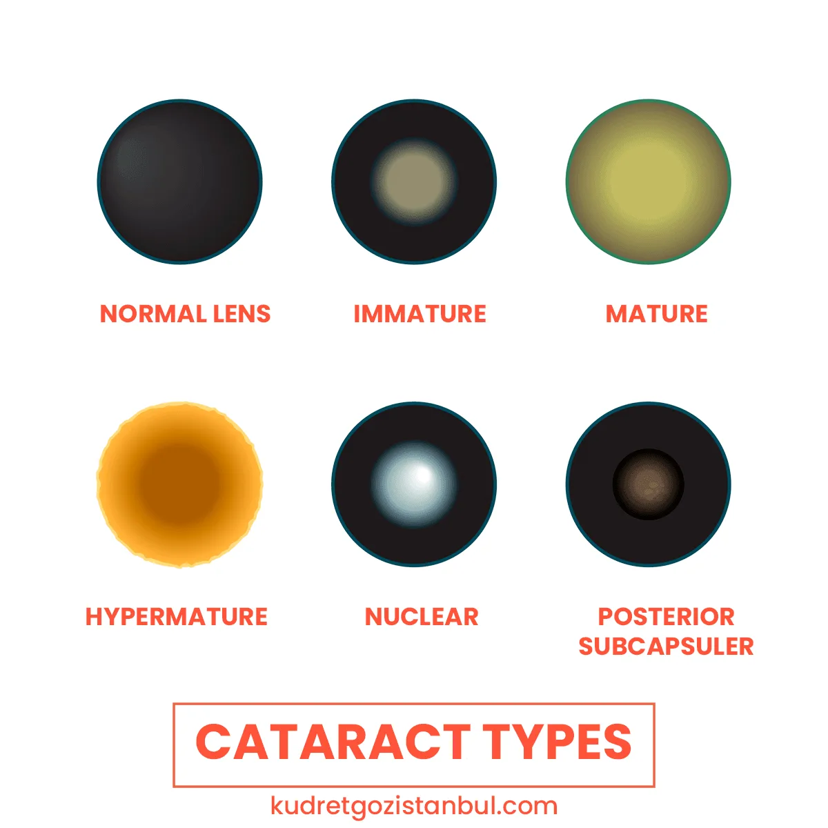 Types of cataract