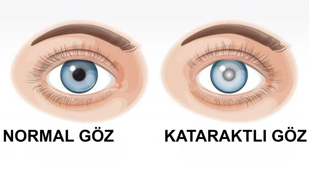 Cataract