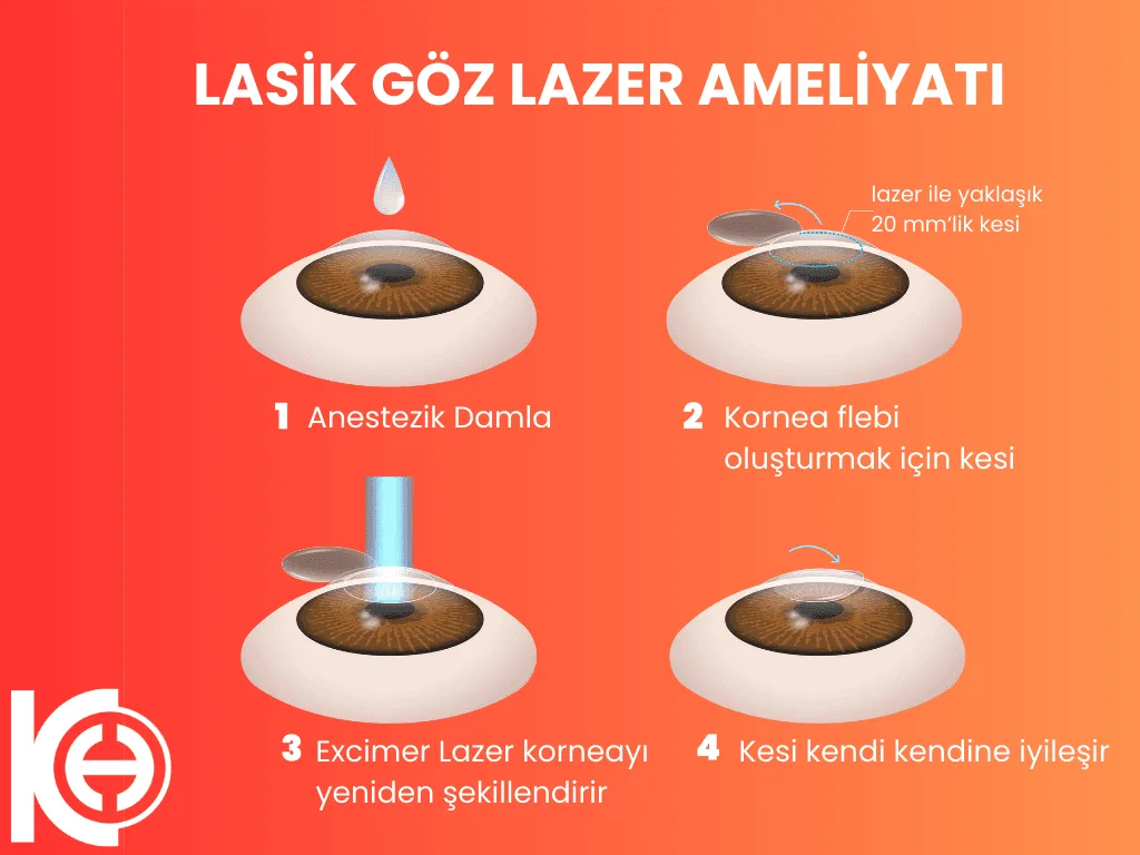 lasik göz ameliyatı nasıl yapılır