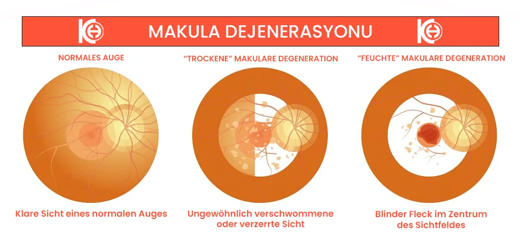 Makula dejenerasyon