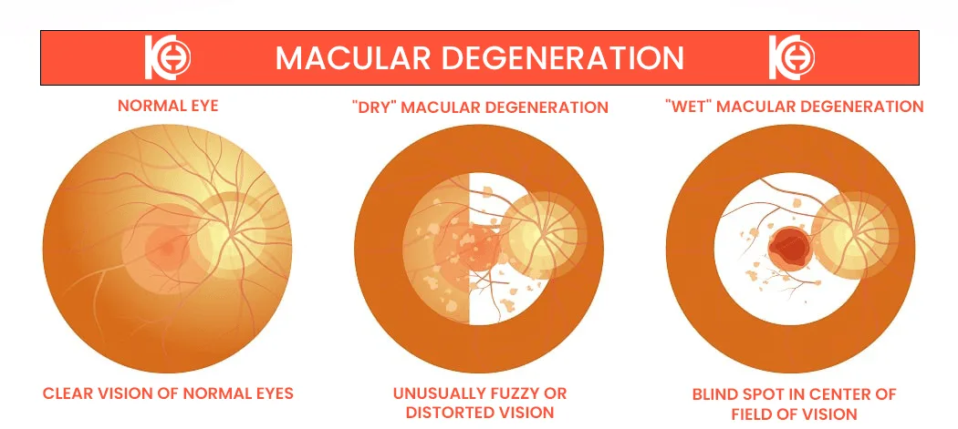 Macular Degeneration