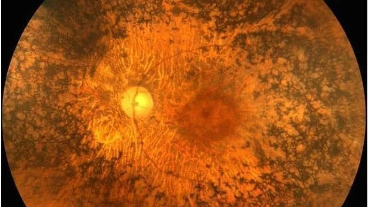 What is Retinitis Pigmentosa?