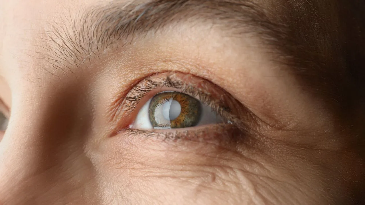 Cataract: klachten, vormen en operatie