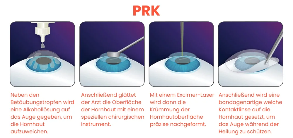 Ablauf der PRK Oberflächenlaserbehandlung