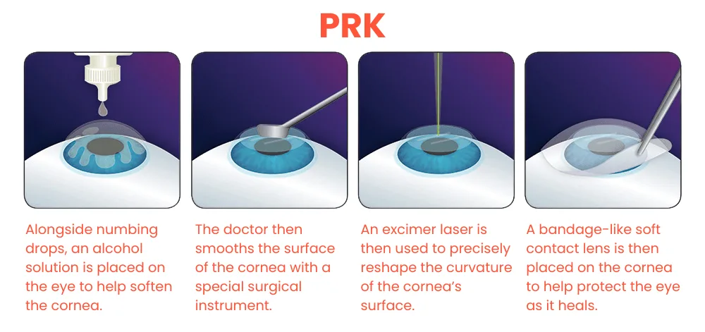 PRK laserbehandeling