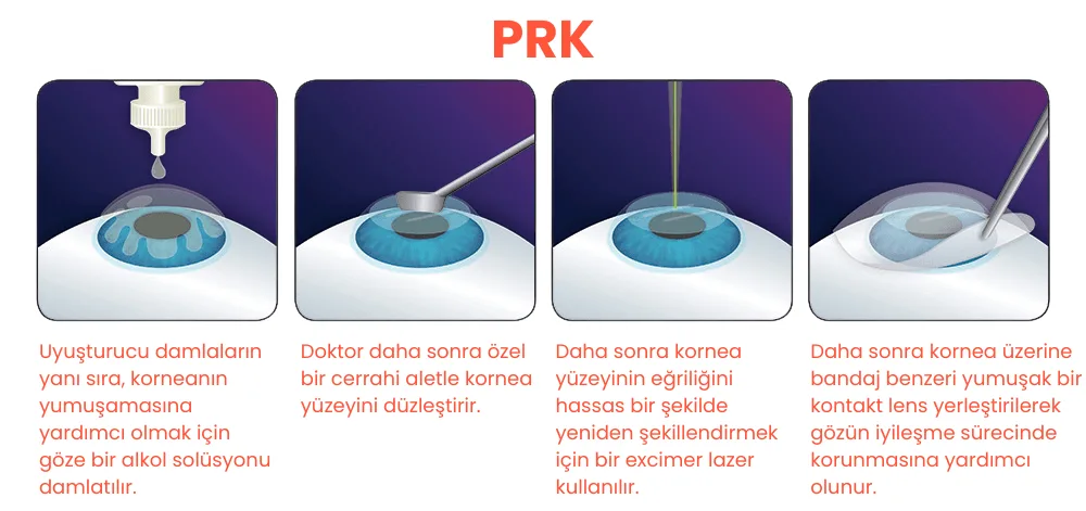 PRK yüzey lazer tedavisinin aşamaları