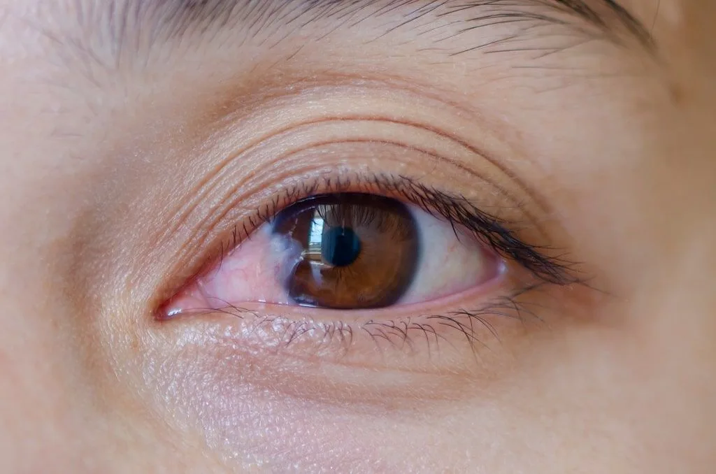 Pterygium