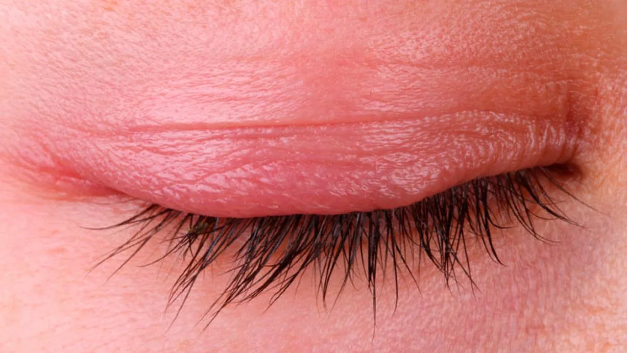 Chalazion