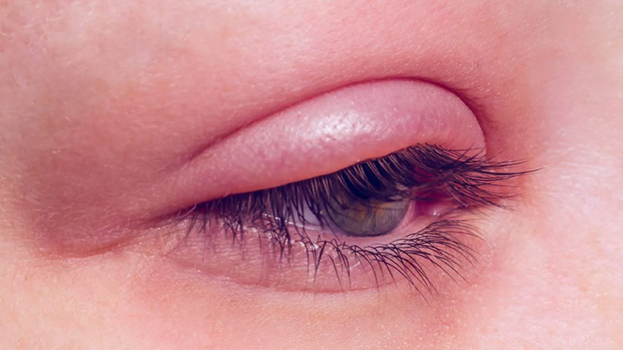 What is a Chalazion (Eyelid Cyst)?