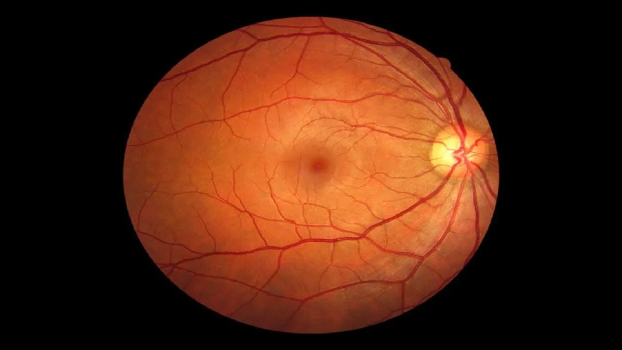Macular disease treatment