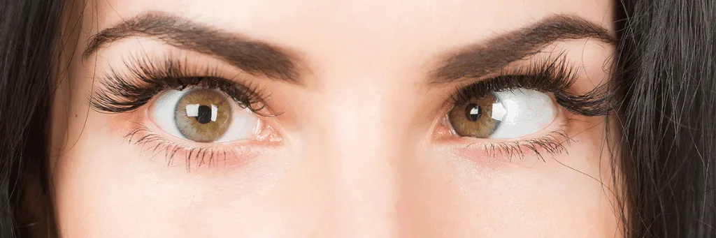 Strabismus