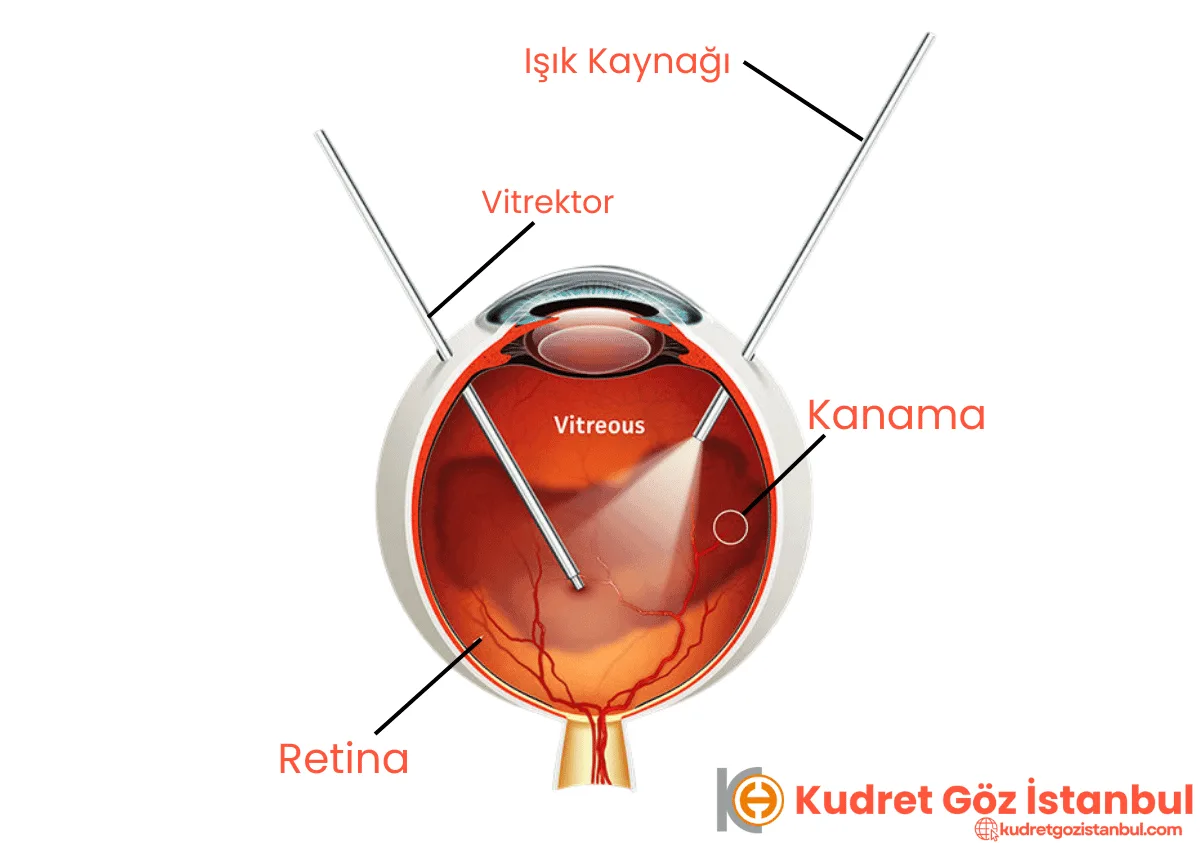 Vitrectomie Operatie