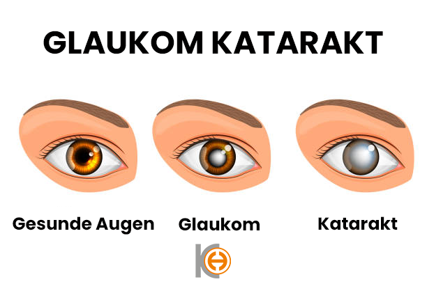 Glaukom 3 Glokom 5 de