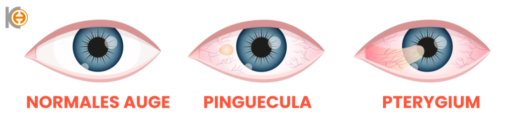 Pterjium 2 DE