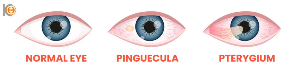 Pterjium 2 EN